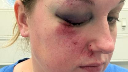 Injuries, blown tyres and repair bills - frustration over 'spike' in potholes